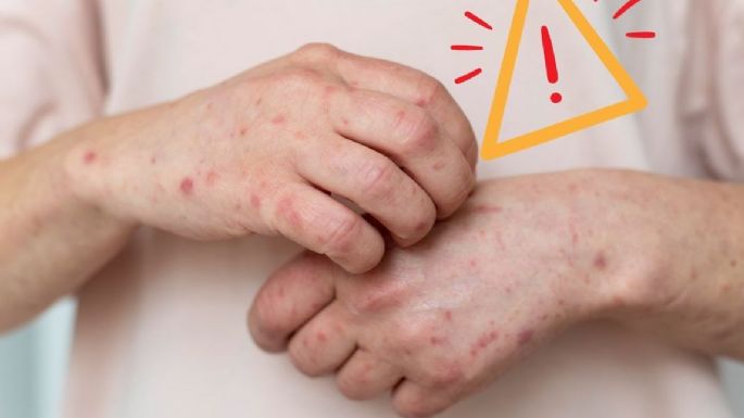 ¿Qué es el sarampión y qué lo causa? Estos son sus síntomas y formas de contagio